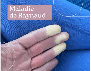 Maladie De Reno Maladie De Reno