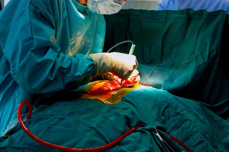 Chirurgie de Hartmann Chirurgie de Hartmann